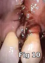 Platelet concentration