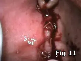 Surgical application