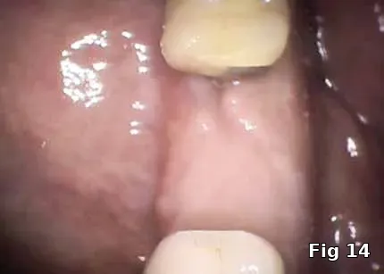 Soft tissue regeneration