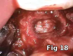 PRGF membrane placement