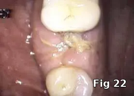 PRGF membrane placement