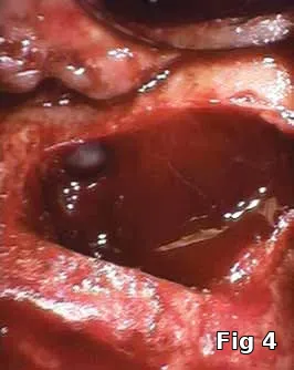 Soft tissue regeneration