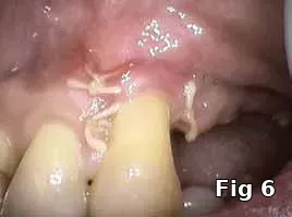 Platelet gel preparation