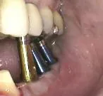 Traditional guide limitations